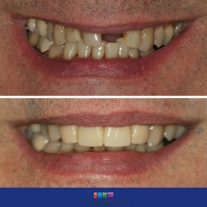 before and after cosmetic dental procedure photo