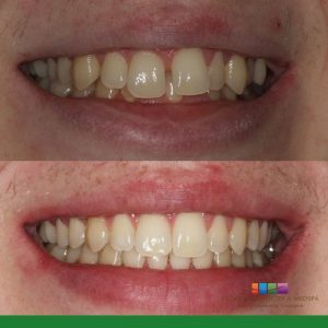 before and after cosmetic dental procedure photo