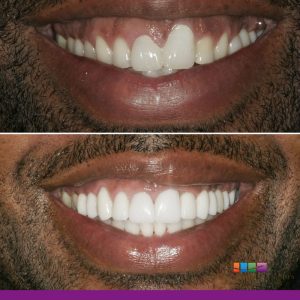 teeth before and after procedure