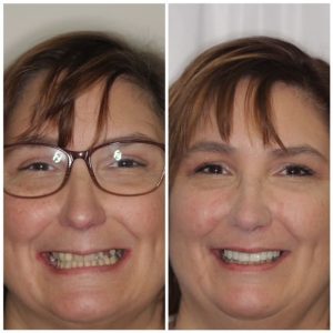 patient before and after dental procedure