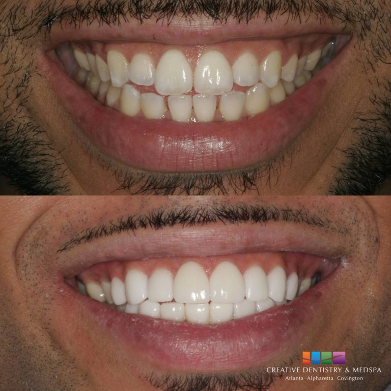 Atlanta GA Dental Lumineers Lumineers vs Veneers Sandy Springs