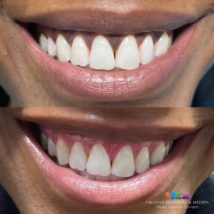patient before and after Gum Bleaching procedure
