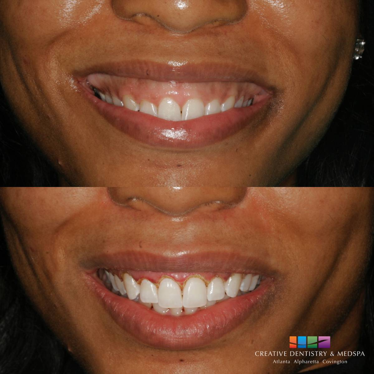 patient before and after Gummy Smile Correction procedure