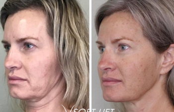 Patient before and after PDO Thread Lift