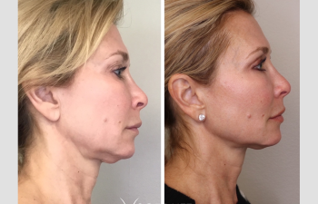 Patient before and after PDO Thread Lift