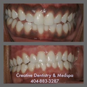 before and after dental procedure. Creative Dentisty and Medspa. 404-883-3287