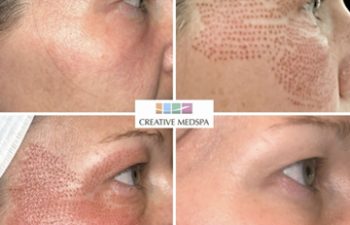patient befor and after plasma pen treatment