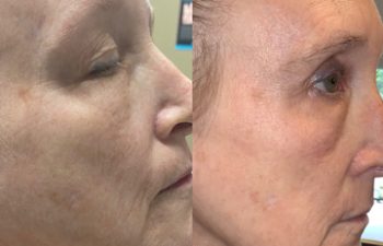 patient befor and after plasma pen treatment
