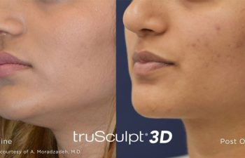 Patient before and after Body Sculpting procedure. truSculpt 3D. Baseline and Post One tx. Photos courtesy of A. Moradzadeh, M.D.