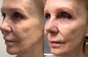 Patient before and after CoolPeel procedure