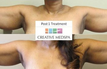 Patient before and after Body Sculpting procedure. Post 1 Treatment.