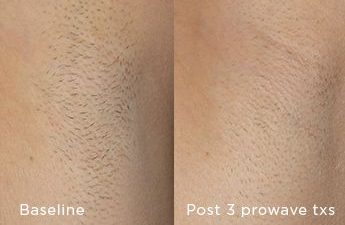 Patient before and after Lasers procedure