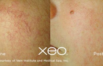 Patient before and after Lasers procedure