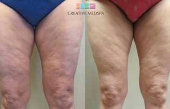 Patient before and after Body Sculpting procedure