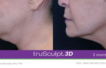 Patient before and after Body Sculpting procedure. truSculpt 3D. Before and 3 months after 1 Tx. Photos courtesy of Macrene Alexiades, M.D., PhD. Face + Body Aesthetic Solutions by Cutera.