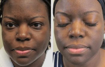 Patient before and after Microneedling procedure
