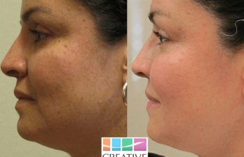 Patient before and after Microneedling procedure