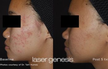 Patient before and after Laser Genesis procedure