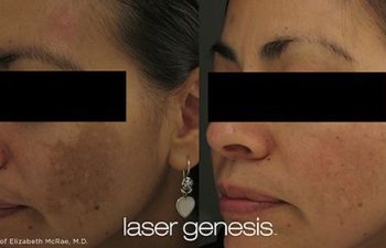 Patient before and after Laser Genesis procedure