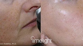 Patient before and after Limelight IPL procedure