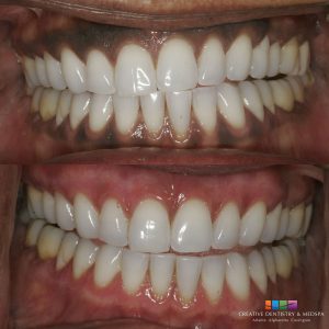 before and after dental procedure. Creative Dentisty and Medspa. 404-883-3287
