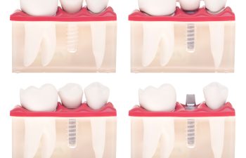 dental model with different types of treatments (implant placement bonded bridge crown over implant) isolated on white background