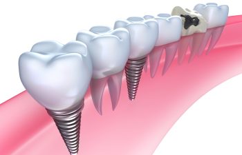 Illustration of dental implants