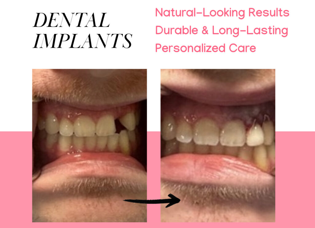 Dental implant and crown: Before and After Photo of the Patient.Dental Implants. Natural-Looking Results. Durable and Long-Lasting. Personalized Care. Free Consultation and same day surgery available.
