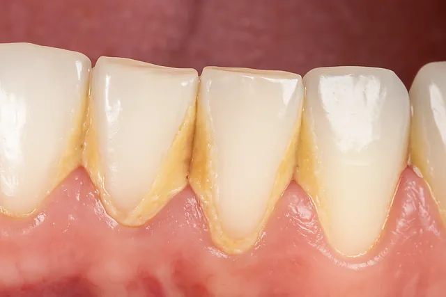 Close-up of lower teeth showing yellow plaque and tartar buildup along the gumline