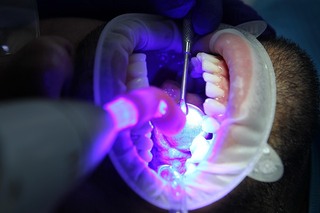 laser whitening at the dentist