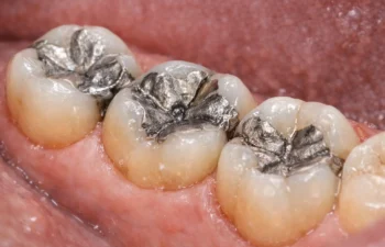 silver fillings for cavities