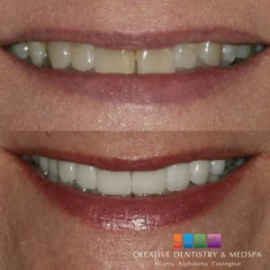 Porcelain veneers