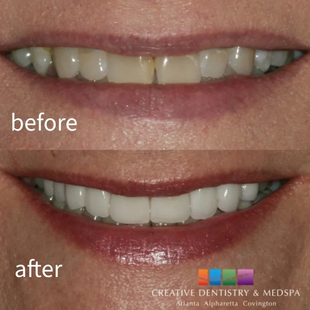 Veneers Before and After Smile Transformation