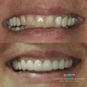 Before and after smile makeover at Creative Dentistry & Medspa in Covington, GA showing brighter, more even teeth.