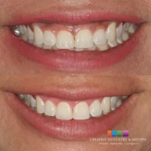 Gum depigmentation in Alpharetta