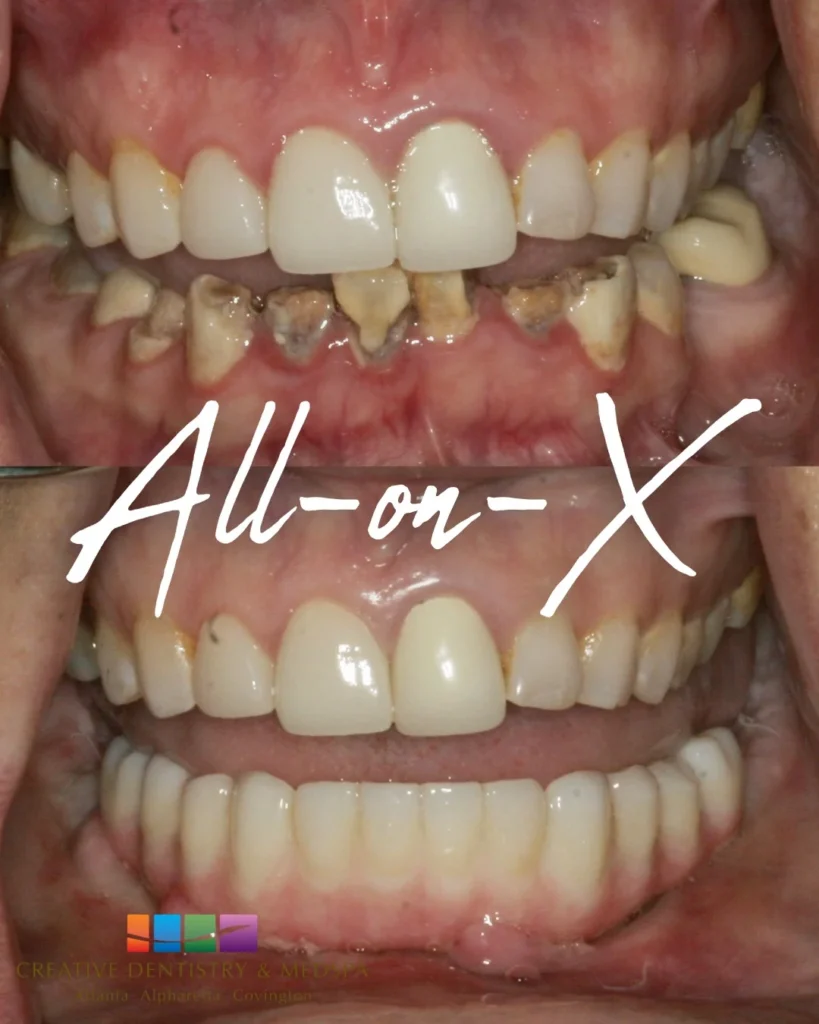 all on x dental implant case